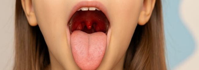 Что такое тонзиллит и как его лечить