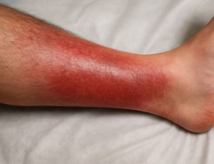 Що таке бактеріальний целюліт і як його лікувати