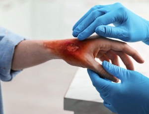 Що варто знати про опіки