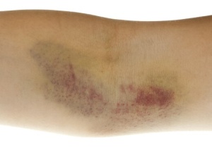 Усе, що потрібно знати про гематому