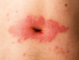 Псоріаз у пупку: причини появи та характерні прояви