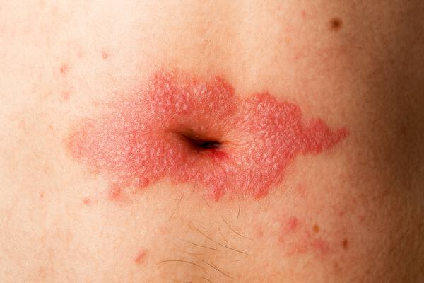 Псоріаз у пупку: причини появи та характерні прояви