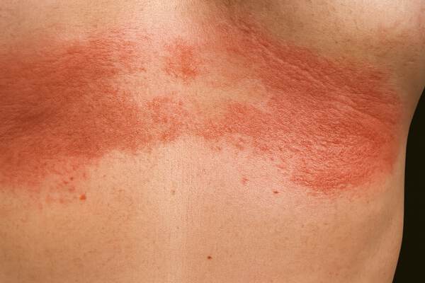 Інтертріго: запалення у складках шкіри