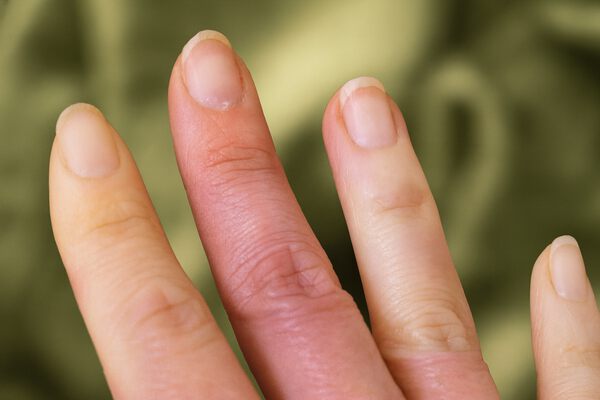 Синдром Рейно: пальці змінюють колір і німіють