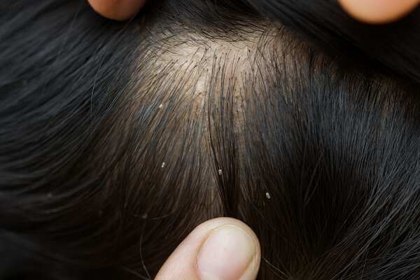 Педикульоз: воші у людини